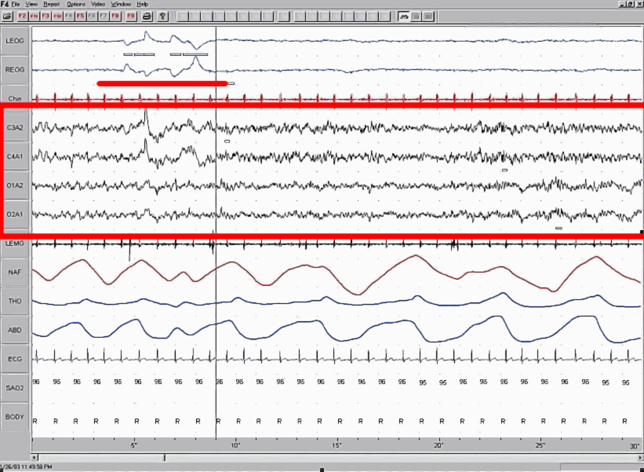 A typical night's hypnogram. REM episodes lengthen as the night progresses; the last REM episode is typically when the most vivid dreams occur.